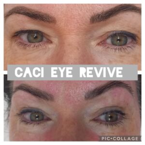 CACI eye revive results